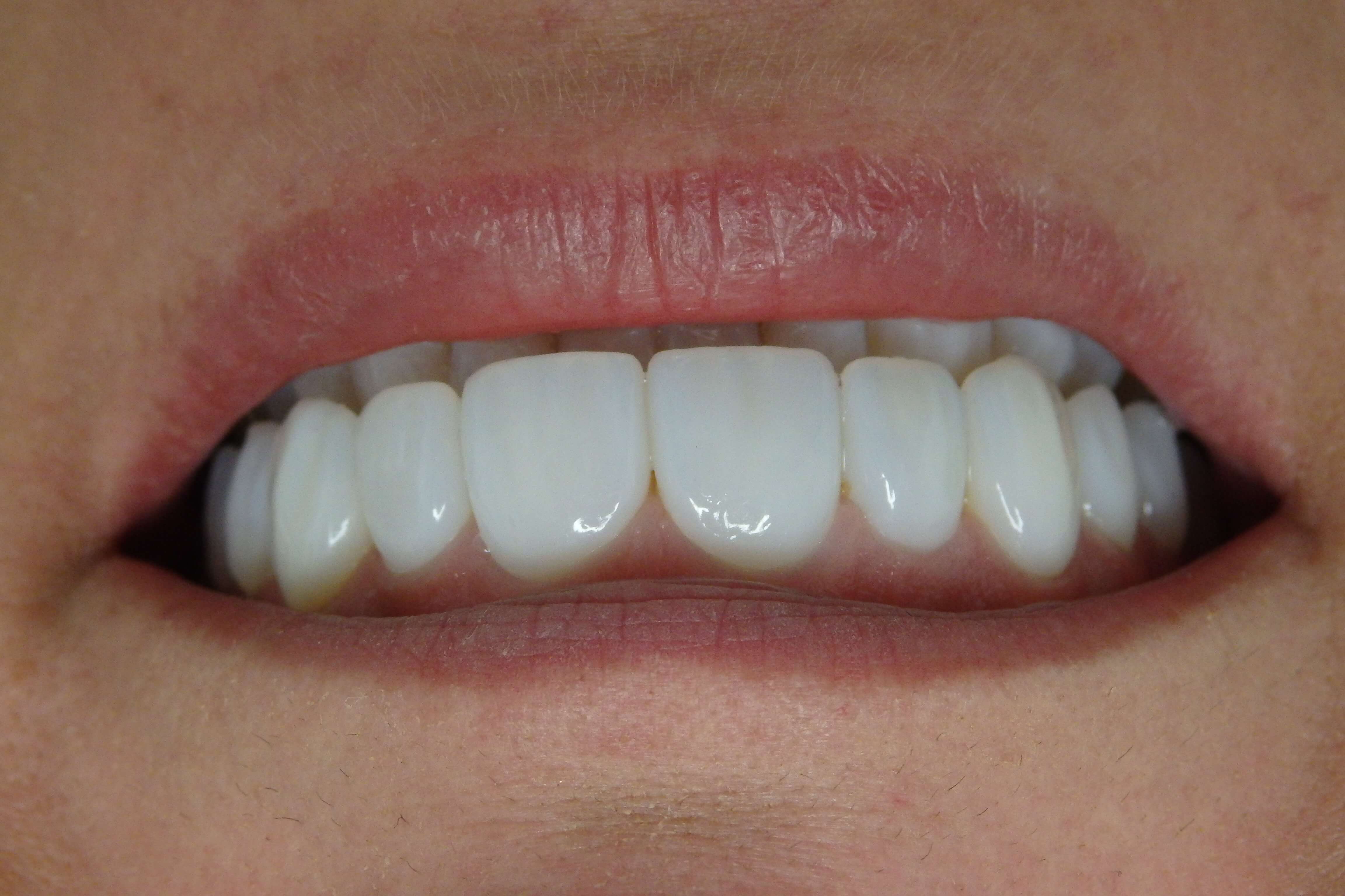 Referenzen Veneers zahnarztluzernzahnklinik.ch